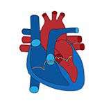 Замена аортального клапана транскатетера (TAVR)